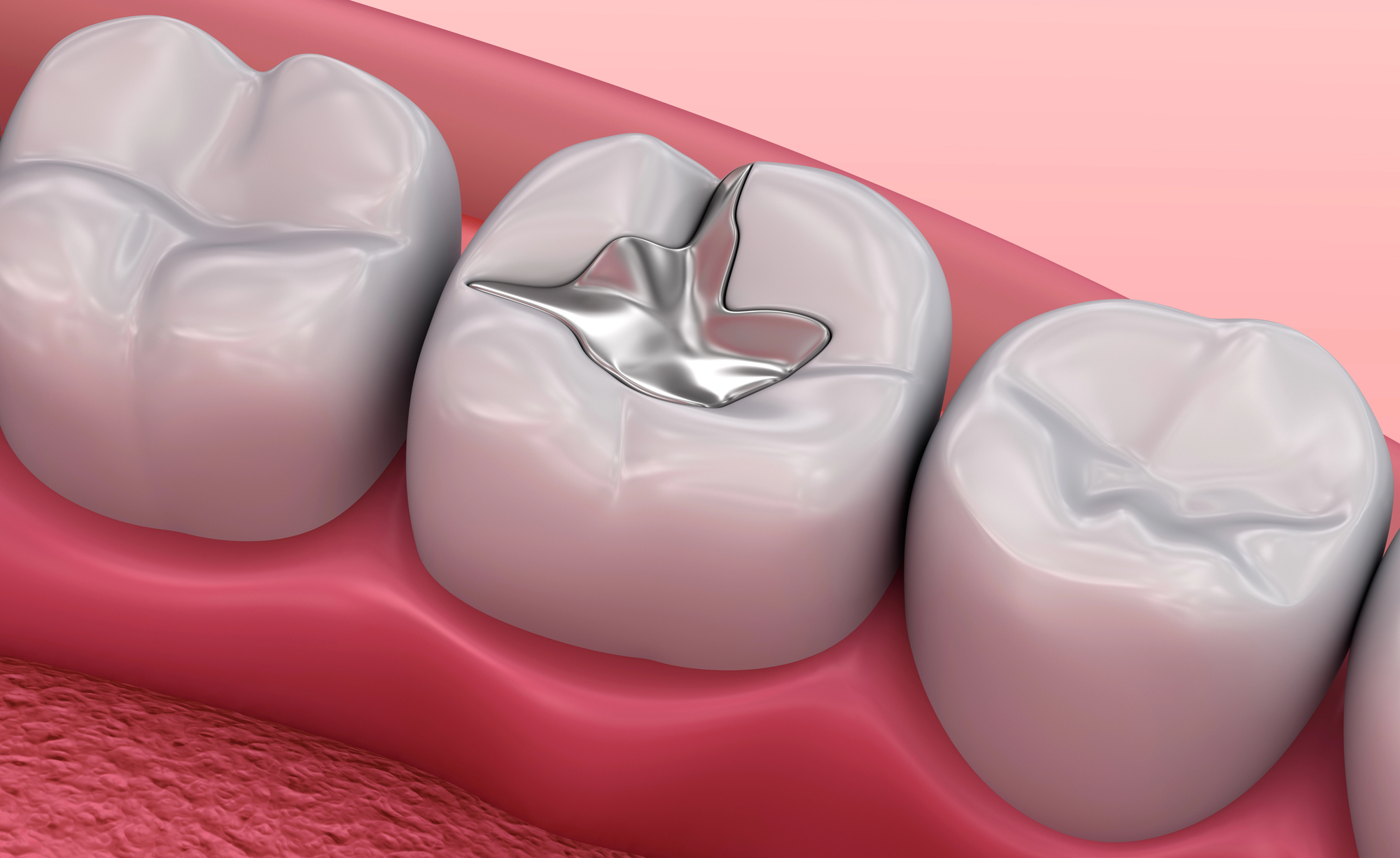 close up of silver dental fillings