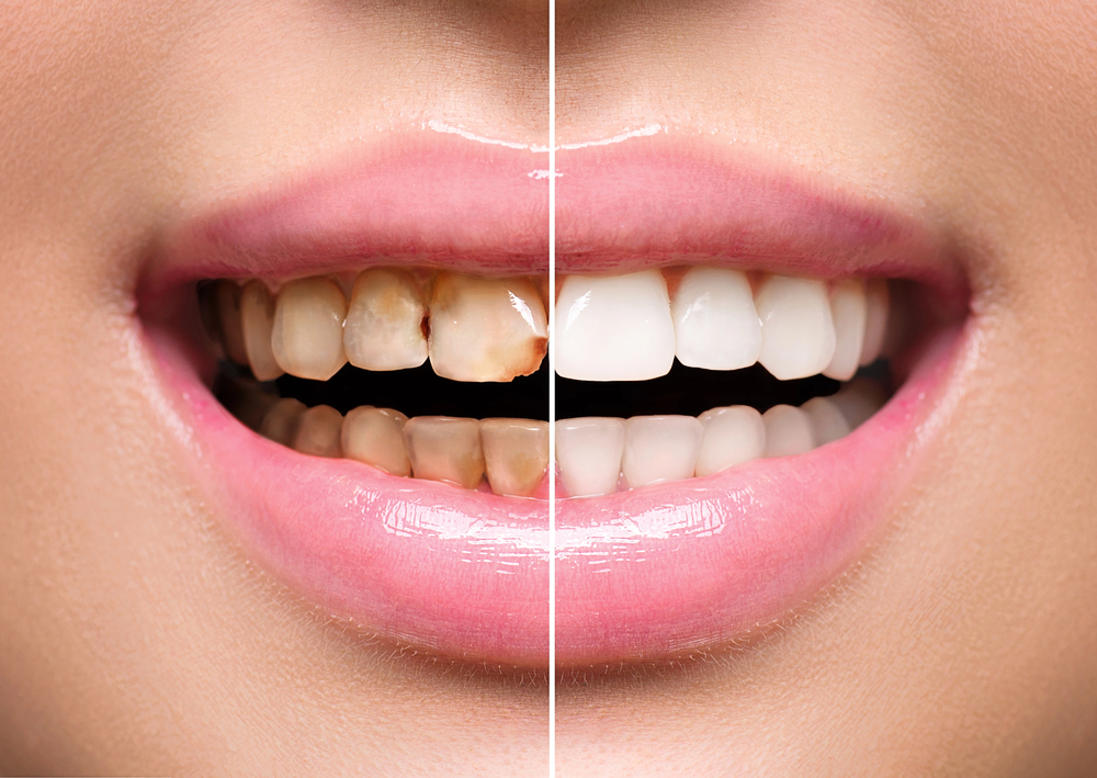 woman's smile before and after cosmetic dentistry treatment