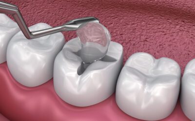 Dental Bonding vs. Dental Fillings: What’s the Difference?