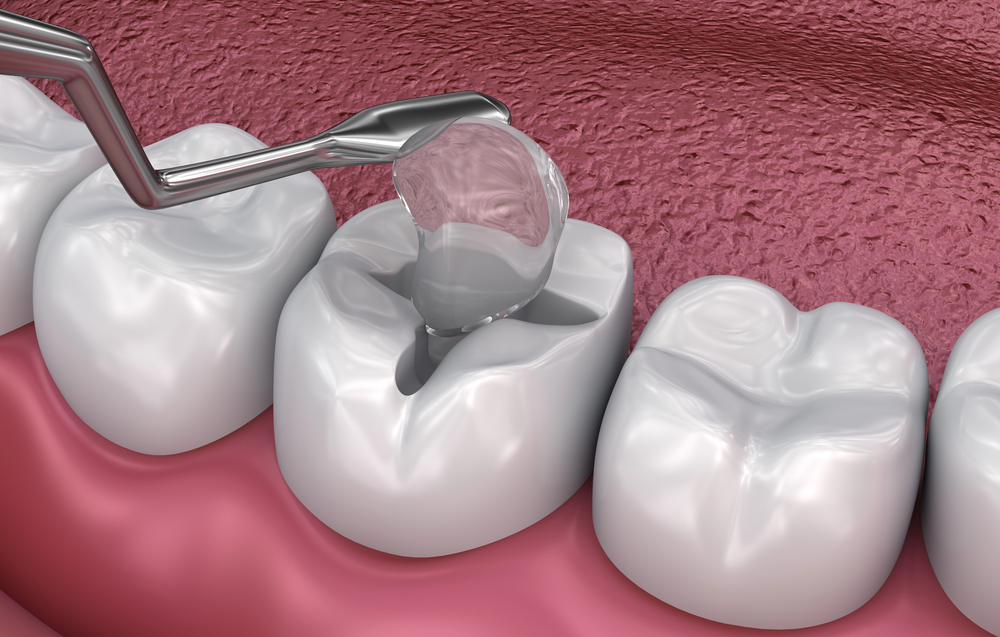 clear dental filling being placed in cavity