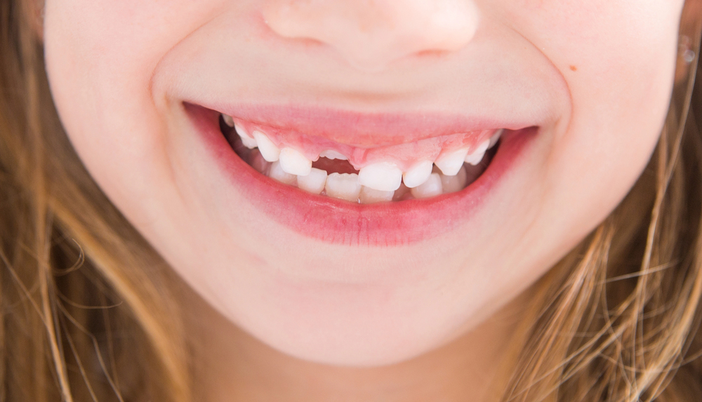 young girl's smile with missing front tooth