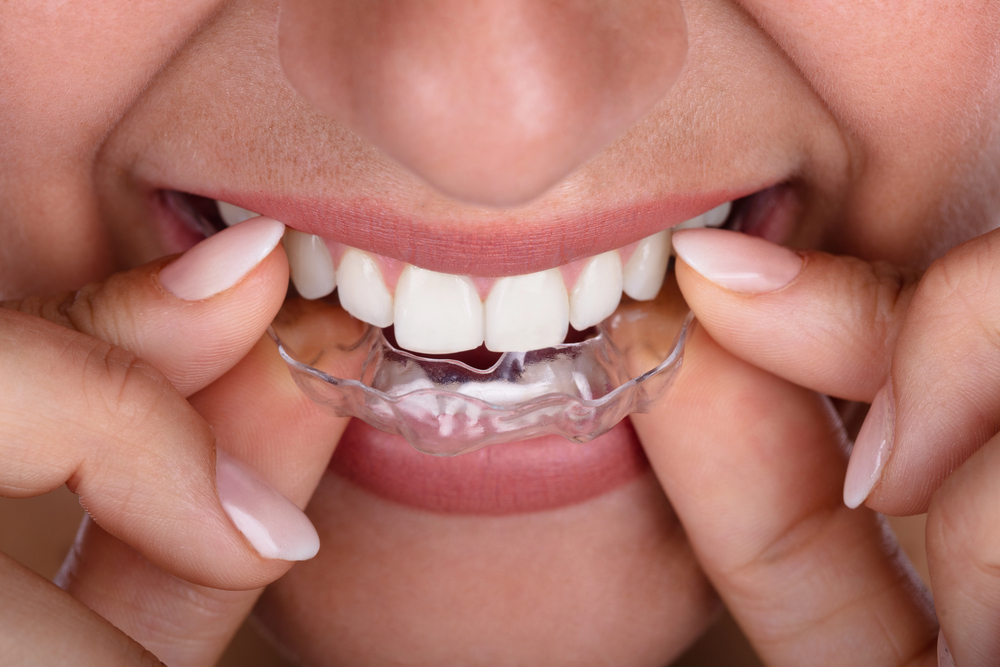 close up of woman placing Invisalign clear aligners in her mouth