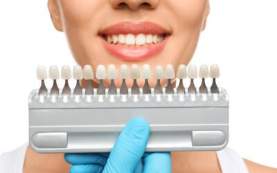 10 Questions to Ask Your Dentist Before Getting Veneers