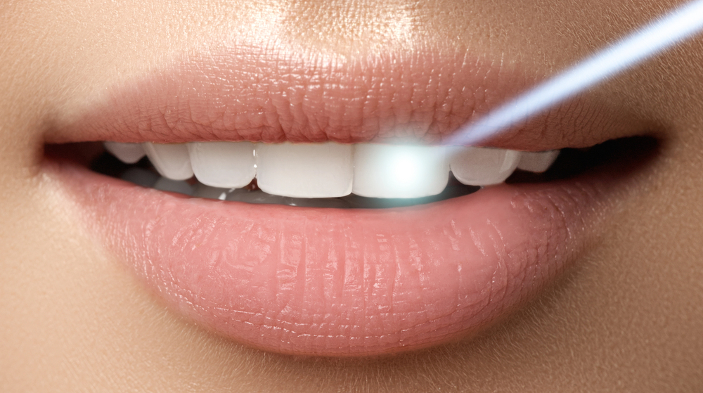 close up of woman getting laser teeth whitening