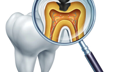 Tooth Canal Alternatives: Are There Other Ways to Treat an Infected Tooth?
