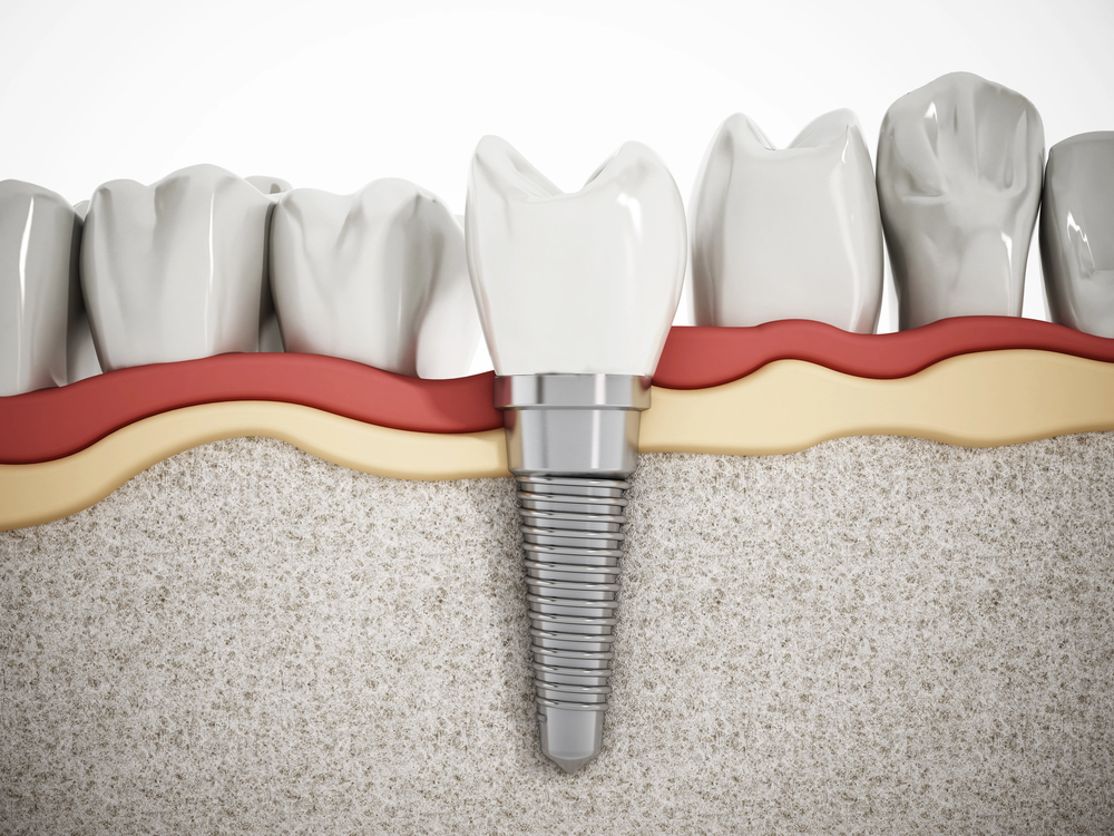 dental implant and crown placed inside of the lower jaw