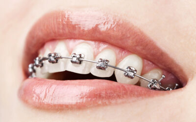 The Hidden Health Benefits of Orthodontics