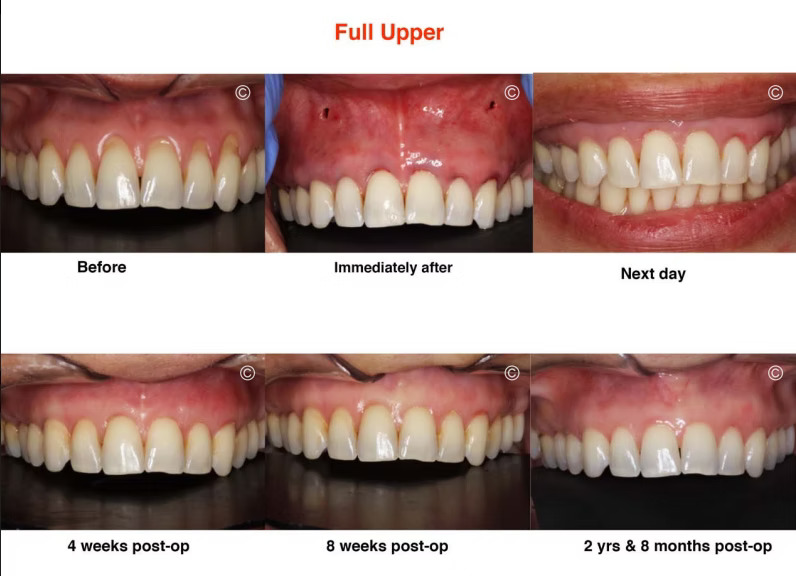 full upper 1