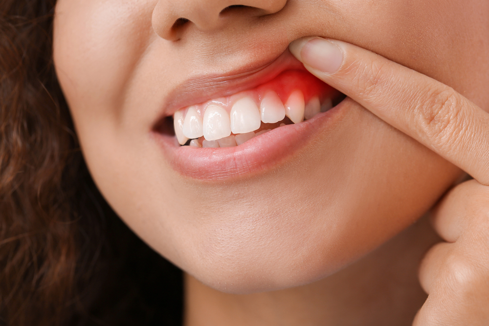 woman holding up her lip, showing red, inflamed gums