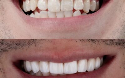Is Cosmetic Dentistry an Indulgence—or Preventive Care for Confidence and Function?