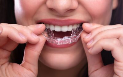 The Modern Smile Makeover: Clear Aligners with Your Dentist in Homewood