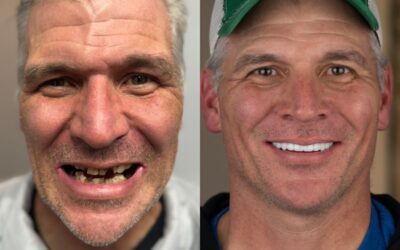 Full Arch Implants vs. Dentures: How Do They Really Compare?