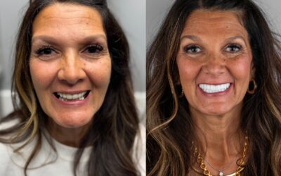 What Are 3 on 6 Dental Implants? A Plain-English Guide to the Three-Bridge Full Arch