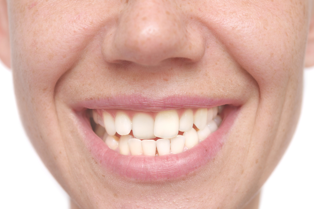 close up of woman with crooked teeth