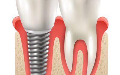 Endosteal Implants: Are They Painful?