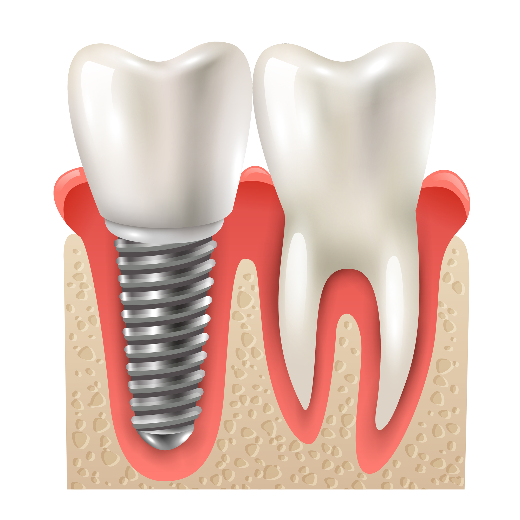 computer-generated rendering of a how a dental implant fits securely and comfortably in the jaw, illustrating the answer to 