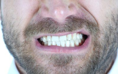Ask a Dentist in Homewood, IL: Is Teeth Grinding Damaging My Smile?