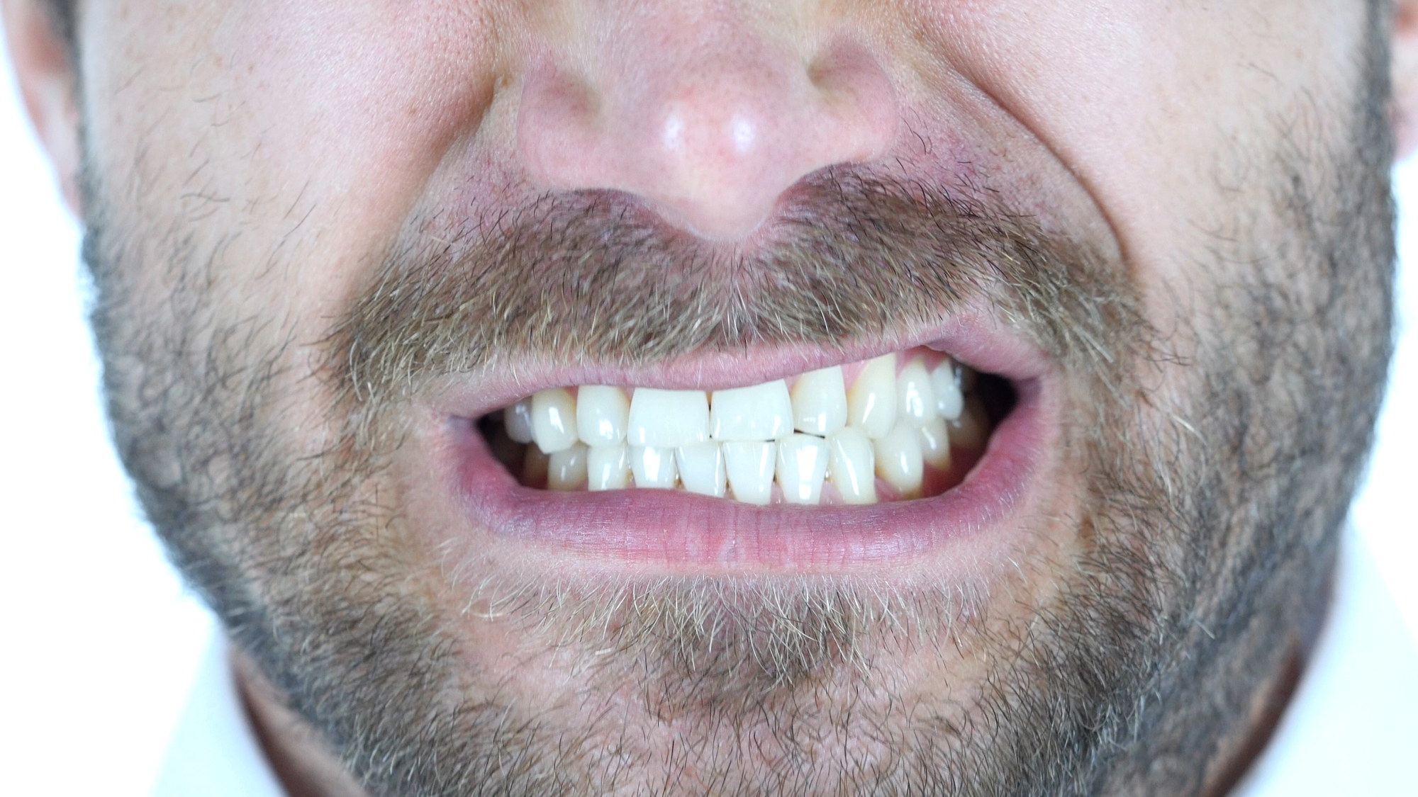 A middle aged white man clenches his teeth together, indicating his need to get bruxism treatment with a dentist in Homewood, IL