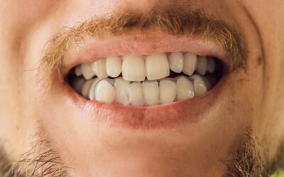 Overbite vs. Underbite: How to Tell Which One You Have