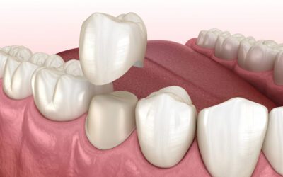 Signs Your Dental Crown Needs to Be Replaced