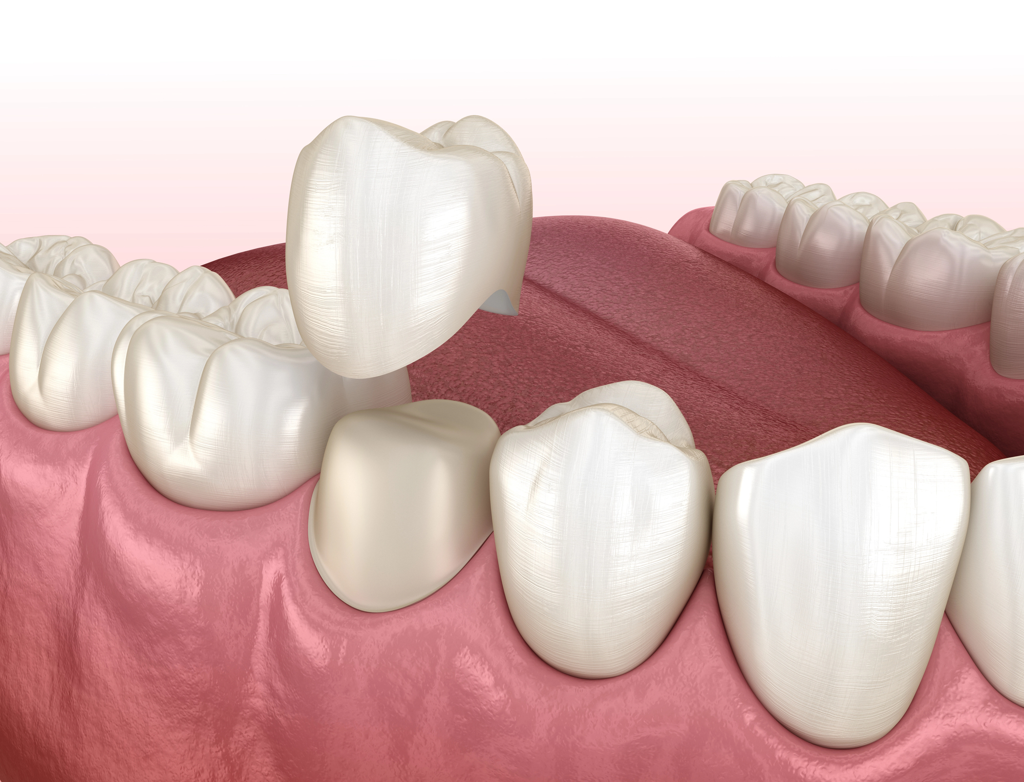a computer-generated image illustrating how dental crowns fit over teeth to protect and repair them.