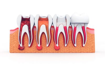 Can Root Canals Fail? Warning Signs to Watch For