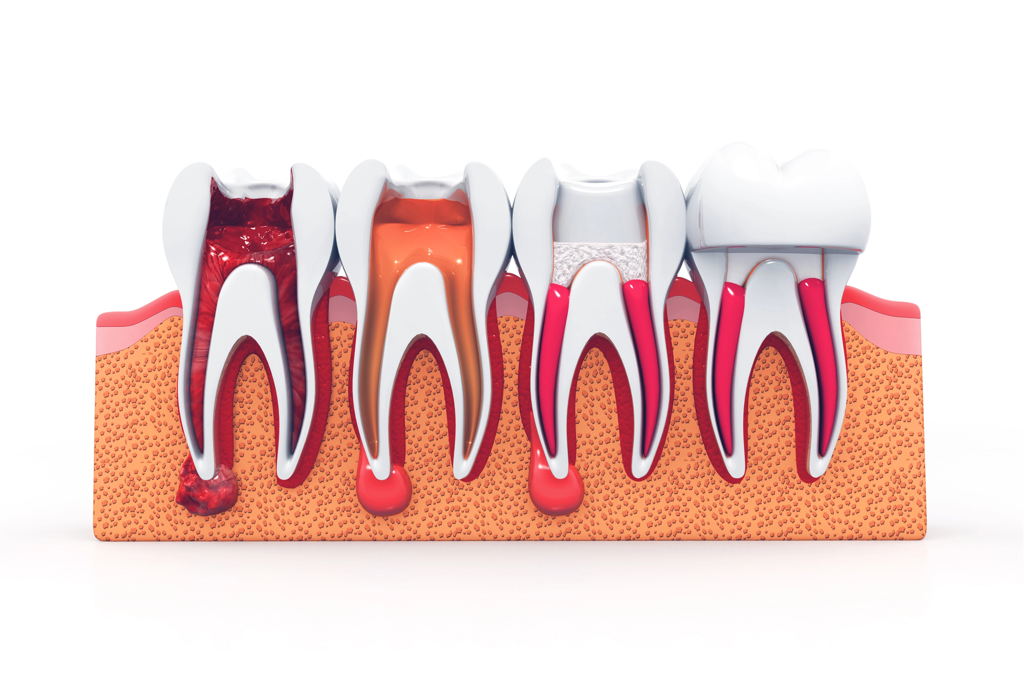 an illustration demonstrating how root canals can get infected and how treatment restores proper function, comfort, and aesthetic