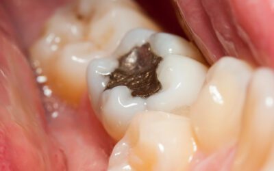 Is Amalgam Dangerous? Your Homewood Dentist + CDC Answer