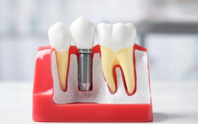 When You’re Missing Teeth: How Your Homewood Dentist Uses 3D Imaging & Sedation for Dental Implants