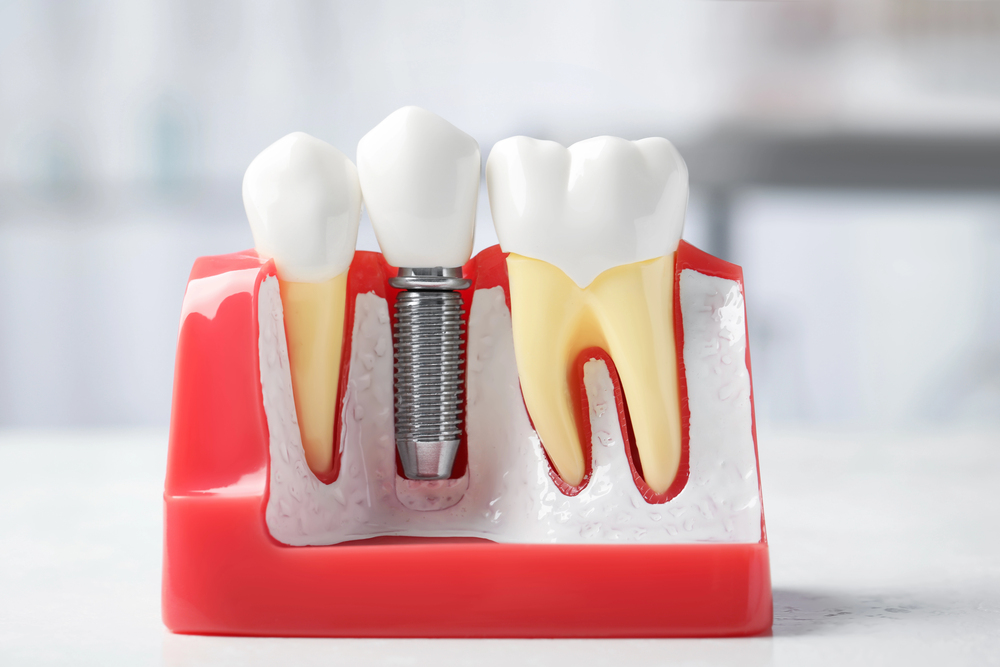 dental implants
