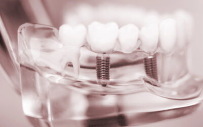 Are Dental Implants Worth It? What Homewood Patients Should Know Before Investing in Their Smile