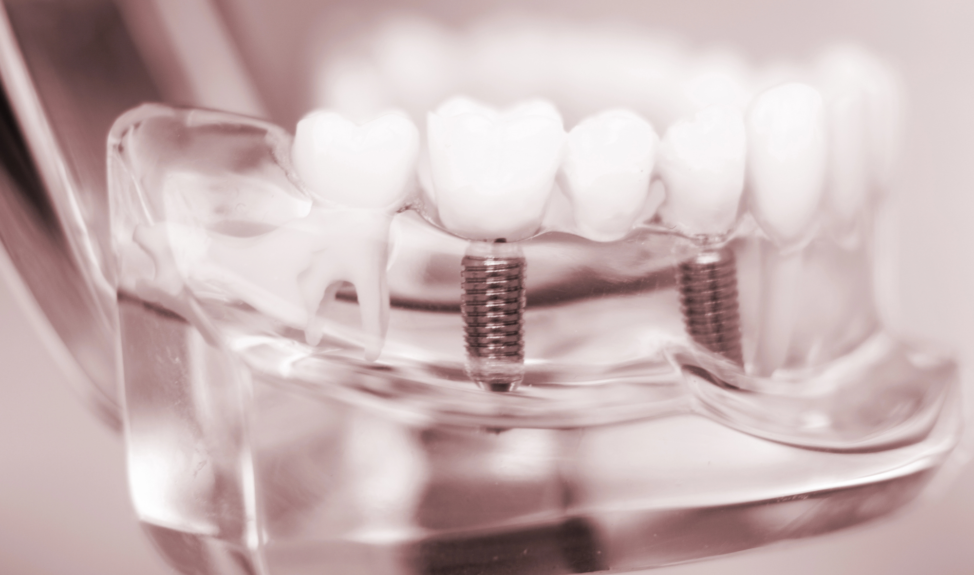 clear acrylic mandible model shows dental implant retained bridge above and below gums.